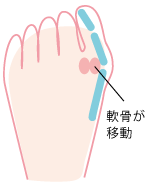 外反母趾の足